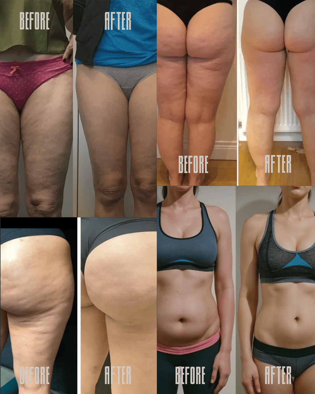 MIRAYA™ – Appareil Professionnel Anti - Cellulite 3 - en - 1 - Miraya